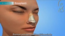 Rinoplasti (Burun Estetigi Ameliyatı) Nasıl Yapılır?