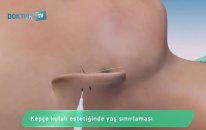 Kepçe Kulak Estetiğinde Nelere Dikkat Edilmeli?