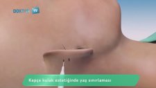 Kepçe Kulak Estetiğinde Nelere Dikkat Edilmeli?