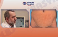 Avrasya Hospital Medical Kadrosunda Yer Alan Op.Dr. Fuat KURŞUN Karın Germe Ameliyatı Hakkında Bilgi