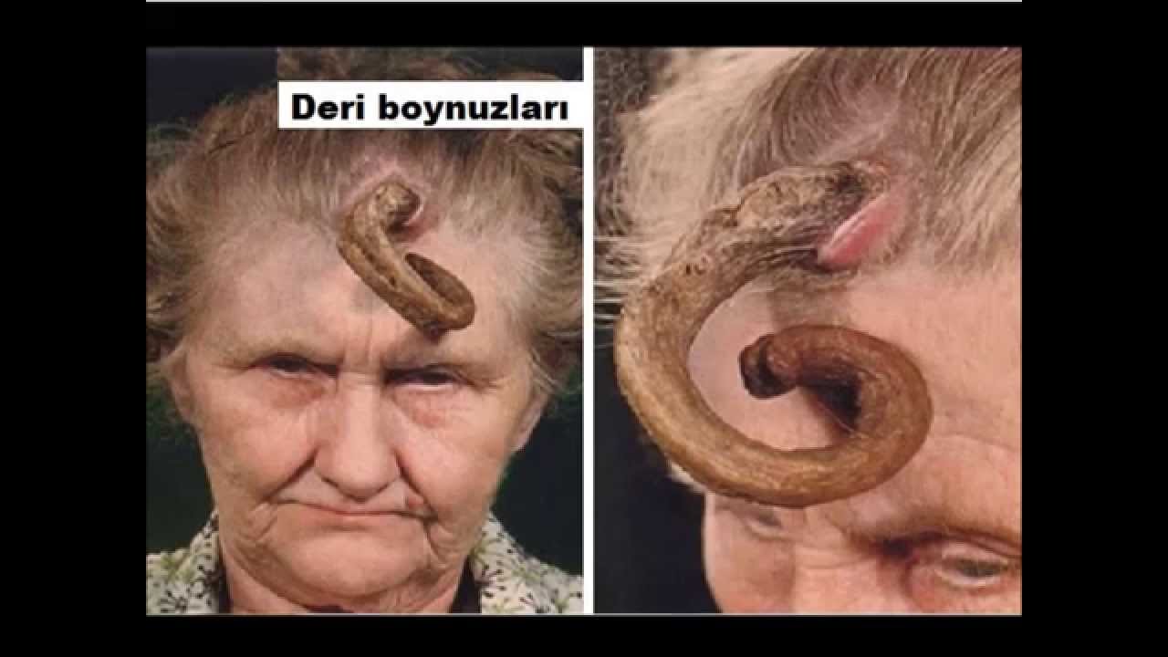 Dünyadaki en korkunç hastalık nedir acaba Dünyadaki en korkunç hastalık nedir acaba