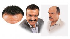 Protez saç nedir saç protezi nasıl yapılıyor protez saç tasarımı nasıl uygulanır istanbul şişli