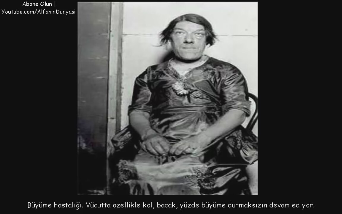 Dünyadaki en korkunç hastalık nedir acaba Dünyadaki en korkunç hastalık nedir acaba