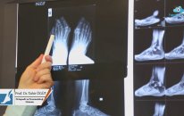 Prof. Dr. Tahir ÖĞÜT - HALLUKS VALGUS NEDİR ?