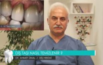 DT. AHMET ÜNAL / DİŞ HEKİMİ - DİŞ TAŞI NASIL TEMİZLENİR?