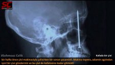Insan vücudundan ameliyatla çikarilmiş 15 garip nesne