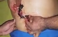 Göbek Deliğinden Fare Çıkması
