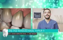 Diş Taşı temizliği nasıl yapılır? - Dt. Hakkı Serdar Ünal