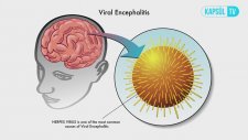 Beyin İltihabı (Ensefalit) Nedir?