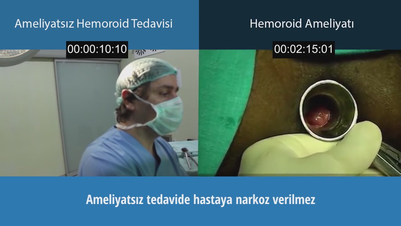 Hemoroid ( Basur ) Nedir Hemoroid ( Basur ) Nedir