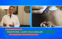 Op. Dr. Sadullah Karun - Fraksiyonel Lazer Uygulamaları