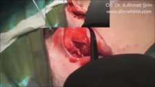 Otoplasty, KEPÇE KULAK AMELİYATI