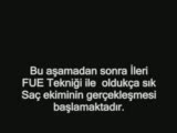 fue tekniği ile saç ekimi
