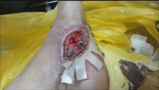 Yara Bakımında Larva Tedavisi