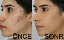 Sivilce-Akne Ve Sivilce Lekesi Nasıl Kapatılır? I How To Cover Acne & Acne Scars