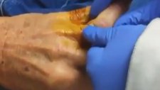 Parmak Eklem Çıkığı Yerine Getirme İşlemi