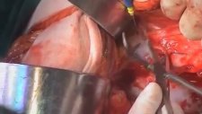Prof Doktor Polat Dursun Ameliyat videoları