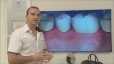 Diş Eti Çekilmesi,Diş Eti Estetiği,Diş Taşı Temizliği;Estetik Gülüş Tasarımı