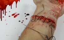 I reattached my hand!