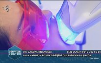 Diş Beyazlatma ve Bonding İşlemi Nasıl Yapılır ?