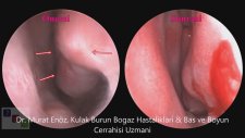 Boş Burun Sendromu Tedavisinde Hyaluronik Asit İle Burun Eti Dolgusu