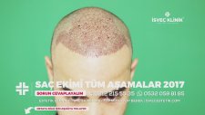 Swedish Clinic Turkey Hair Transplant