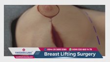 Breast Lift Surgery to Correct Saggy Breasts