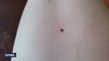 Nane Yağı ile Kene Çıkartma Operasyonu