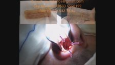 Septum Perforasyonu Ameliyatı