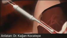 Ivf (Tüp Bebek) ve Mikroenjeksiyon Nasıl Yapılır? (Animasyon)