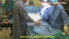 Sezaryen ile doğum nasıl yapılır?-Ameliyathane görüntüleri-Dr. Kağan Kocatepe